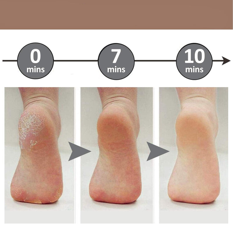 Soft Feet - Removedor de Calos Rachaduras dos Pés - Miston